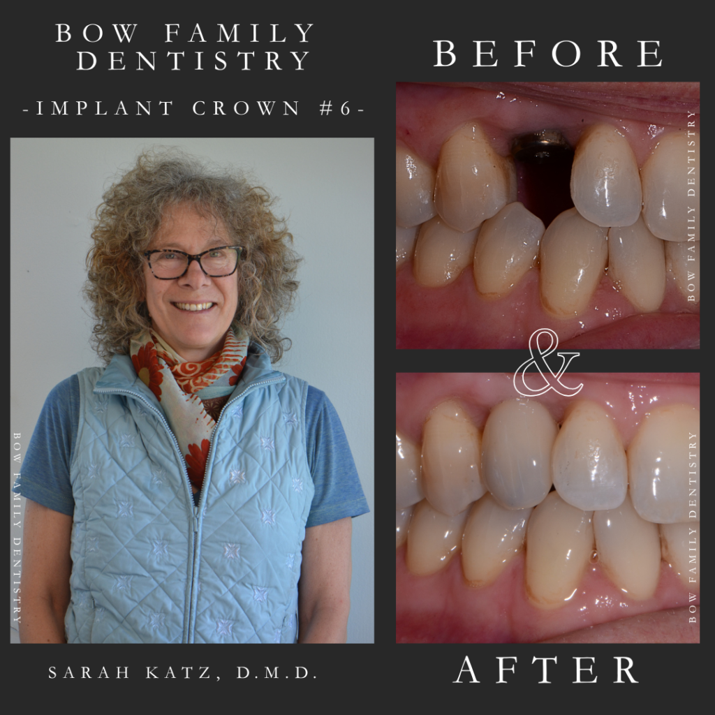 Dental implant and crowns patient before and after photo at Bow Family Dentistry