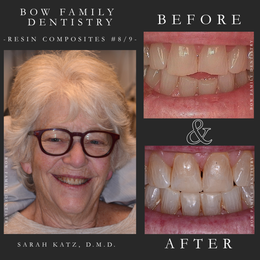 Resin composites real patient before and after photos in Manchester, NH