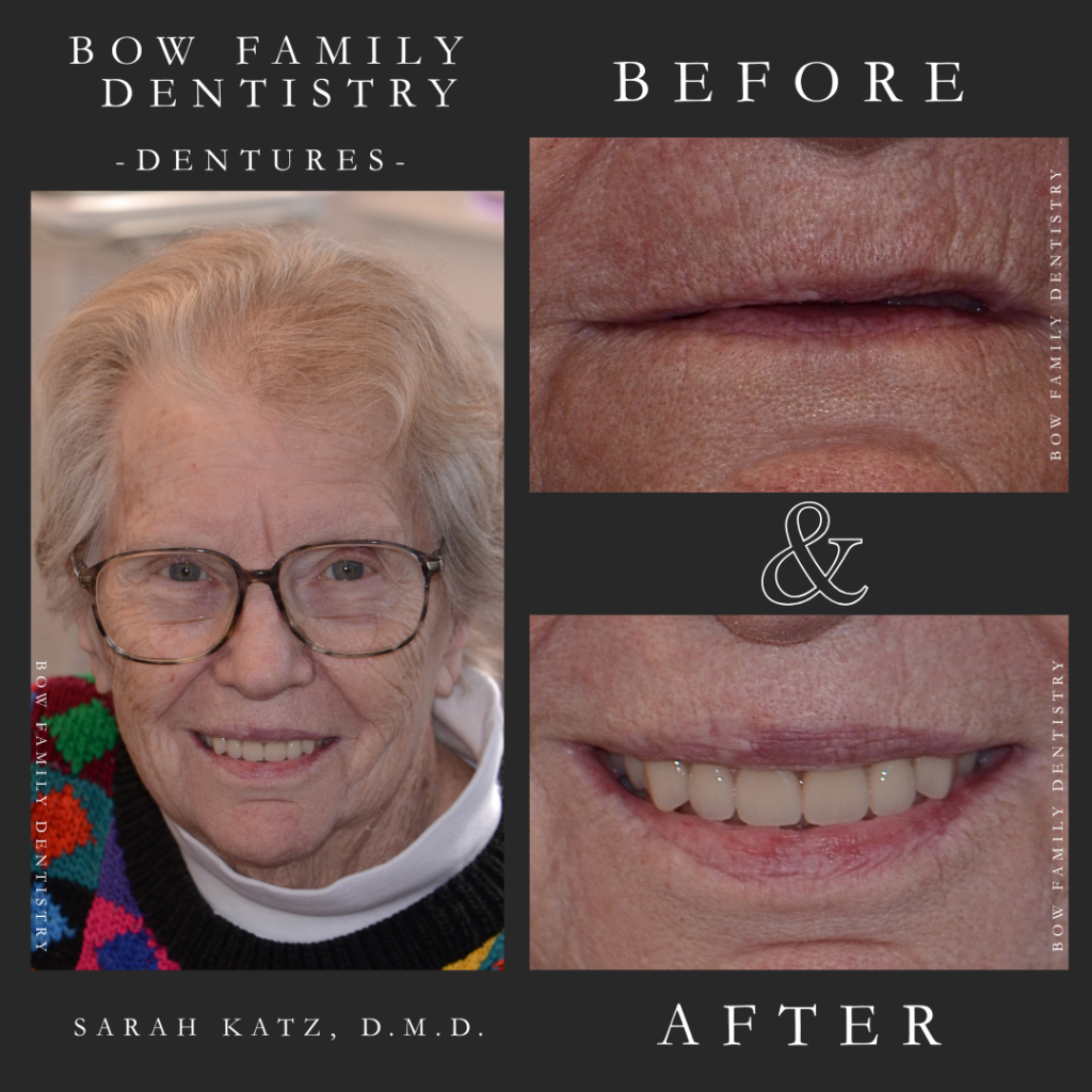 Elderly dentures patient before and after replacing missing teeth with full dentures in Manchester, NH