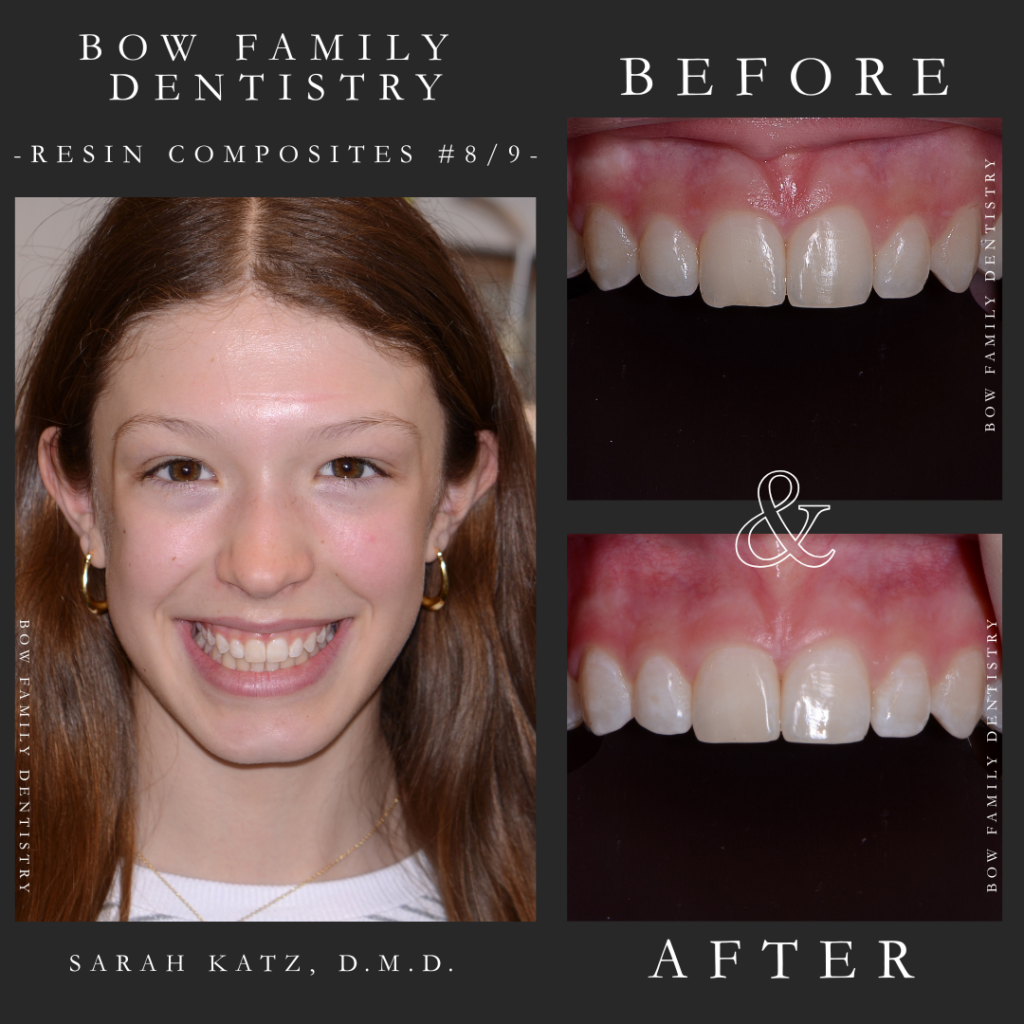 Resin composites dental procedure patient before and after photos in Concord, NH