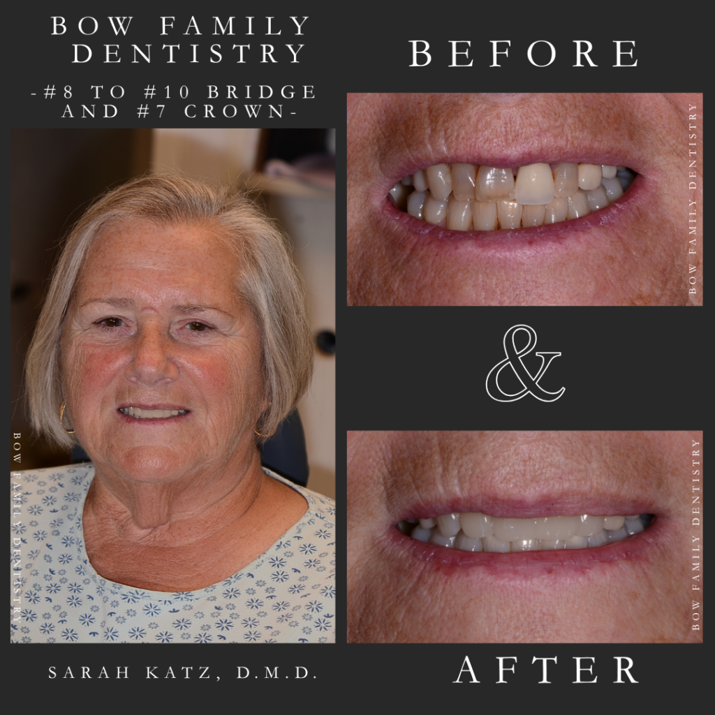 Real patient before and after photos of Concord, NH, dental bridge patient