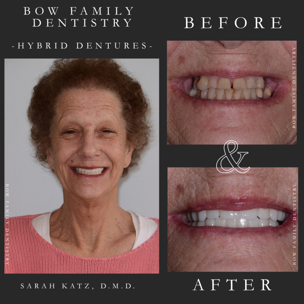 Hybrid dentures before and after photos of female dental restoration patient in Bow, NH