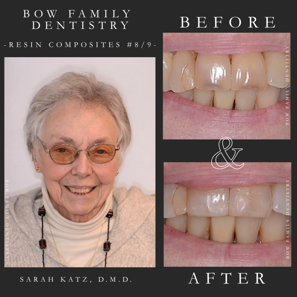 Composite bonding dental repair real patient of Dr. Katz before and after photos in Manchester, NH