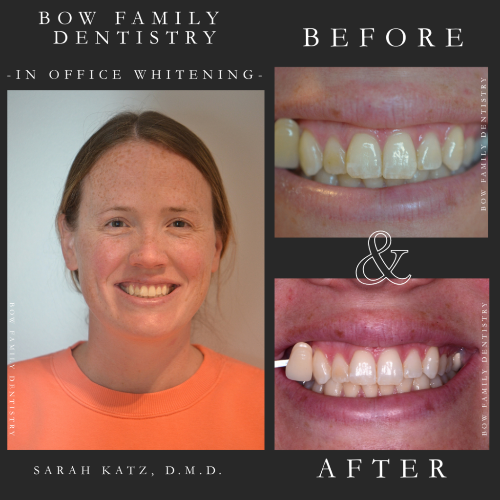 Concord, NH in office teeth whitening patient of Dr. Katz before and after photos