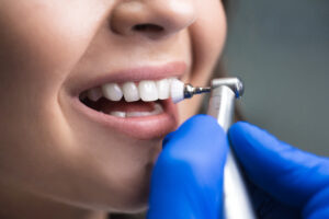 professional dental cleaning procedure close up