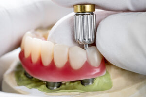 Closeup/ Dental implants supported overdenture on blue background/ Screw retained/ implant restorations