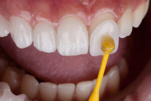 closeup of a dental veneer application