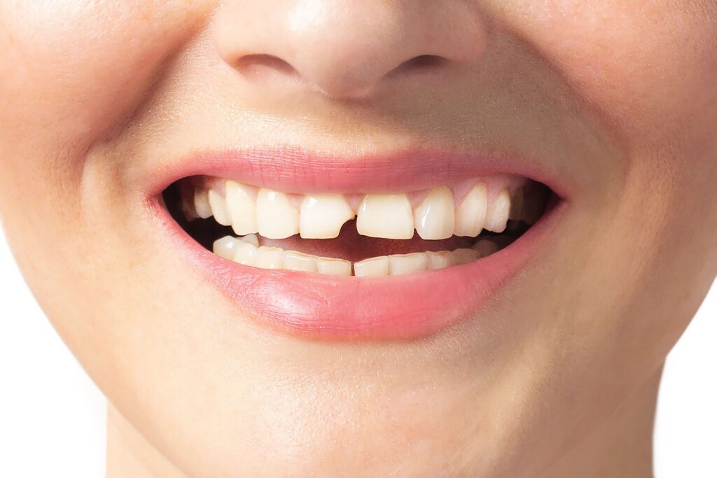 closeup of a chipped front tooth
