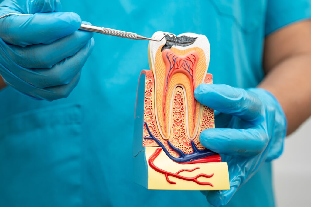dentist in blue gloves showing a model tooth, infection, need for a root canal