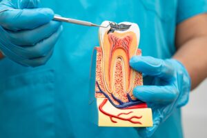 dentist in blue gloves showing a model tooth, infection, need for a root canal